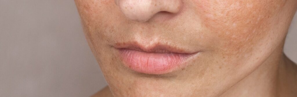 Manchas e Melasma