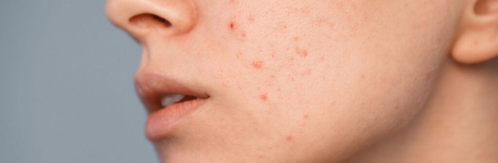 Reduzir a acne (espinhas)
